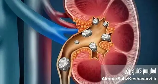 علائم، درمان و باورهای غلط درباره سنگ کلیه