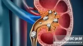 علائم، درمان و باورهای غلط درباره سنگ کلیه
